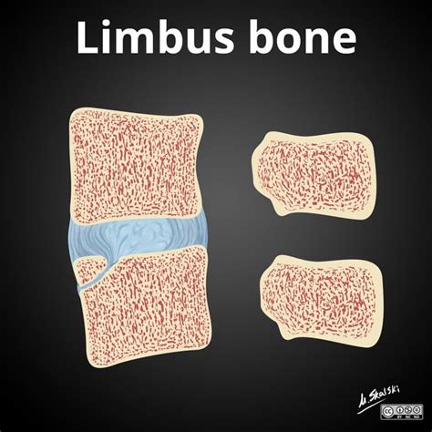 Limbus vertebra vs intercalary bone - illustration | Radiology Case ...