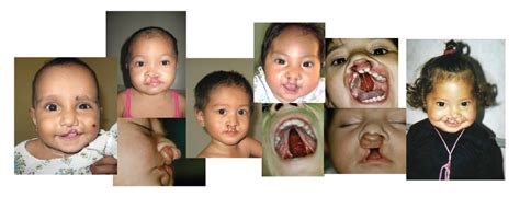 Cleft Lip And Cleft Palate What Causes Cleft Lip Fami - vrogue.co