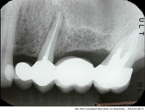 Vertical root fracture diagnosis of crowned premolars with root canal treatment – Two case ...