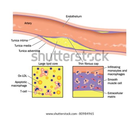 Atheroma Plaque Artery Wall Stock Vector (Royalty Free) 80984965