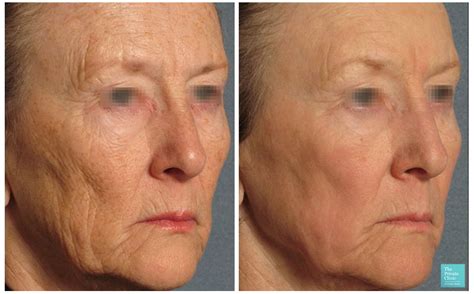 Best Non-Surgical Anti-aging Treatments 2022, Top 7 wrinkle treatment UK