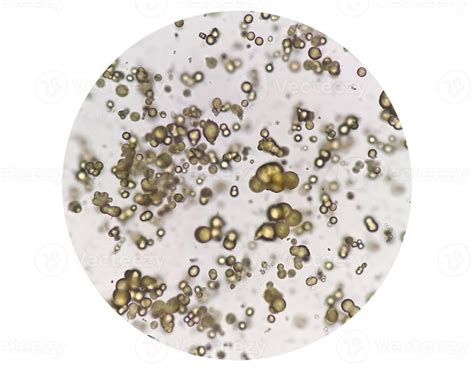 Microscopic image of Urinalysis. Abnormal urine exam. Uric acid ...