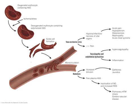 Pathophysiology of sickle cell disease – McMaster Pathophysiology Review