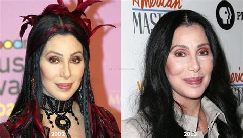 Cher Plastic Surgery Before and After – Celebrity Dr.