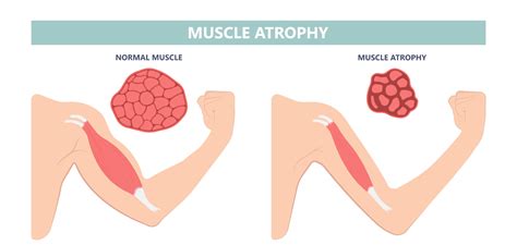 Understanding spinal muscular atrophy | Happiest Health