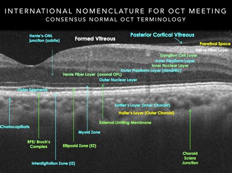 The Official OCT Interpretation | Opthalmic technician, Optometry ...