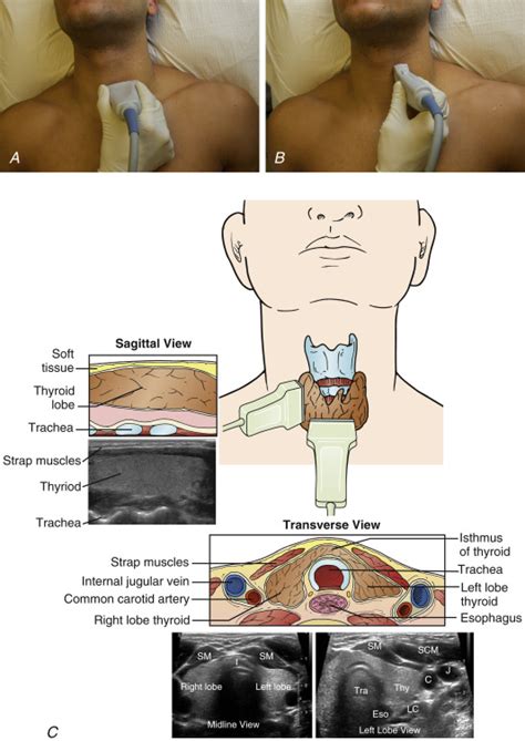 Thyroid Gland | Radiology Key