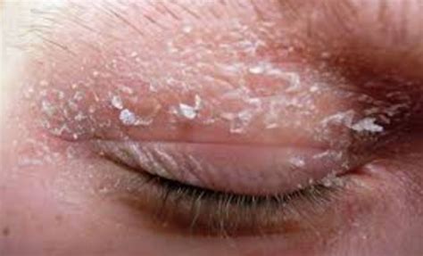 Dry Skin on Eyes, Nose, Ear, Hands or Legs Remedies - Skincarederm