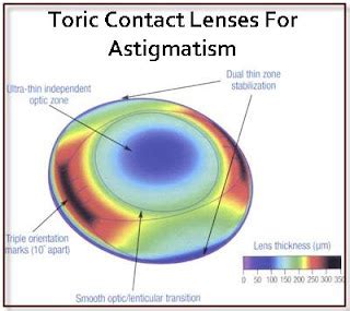 Pictures & Images: Toric Contact Lenses For Astigmatism