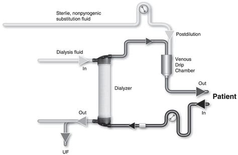 Hemodiafiltration | Abdominal Key