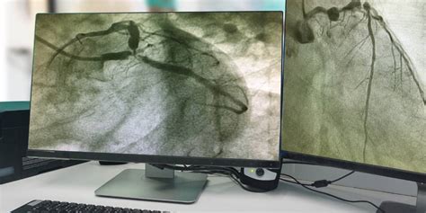 What is Angiography and is it a risky procedure?