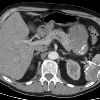 Axial contrast enhanced CT scan of the upper abdomen showing lipiodol ...