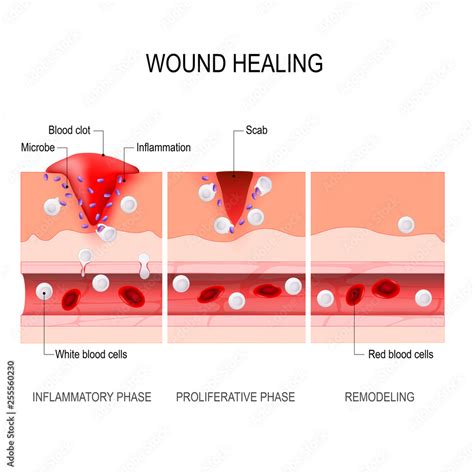 wound healing process. Tissue injury and inflammation. Stock Vector | Adobe Stock