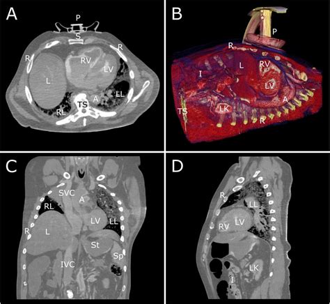 New 3D CT scanning method shows what happens during CPR • healthcare-in-europe.com