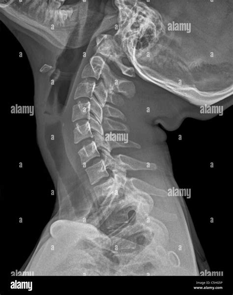 Normal Neck Curve X Ray