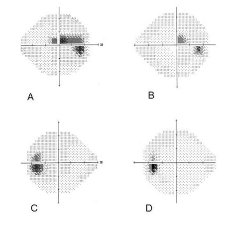 (A) 24-2 Humphrey visual field (HVF) revealing enlarged blind spot with... | Download Scientific ...