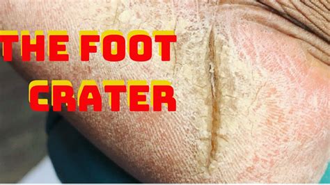 Deep Foot Crater!! How to shave and eliminate foot callus and fissures||Deep Foot Callus - YouTube