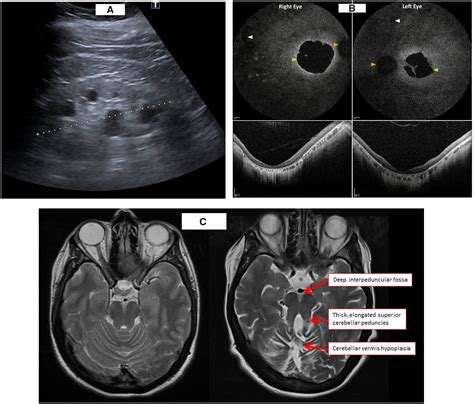 Interpeduncular Fossa Mri