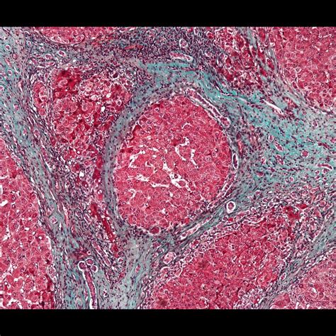 Cirrhosis Histology