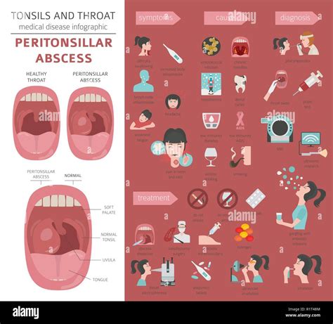 Tonsils and throat diseases. Peritonsillar abscess symptoms, treatment icon set. Medical ...