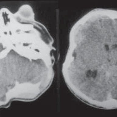 Pfeiffer syndrome type 2-physical aspects. | Download Scientific Diagram