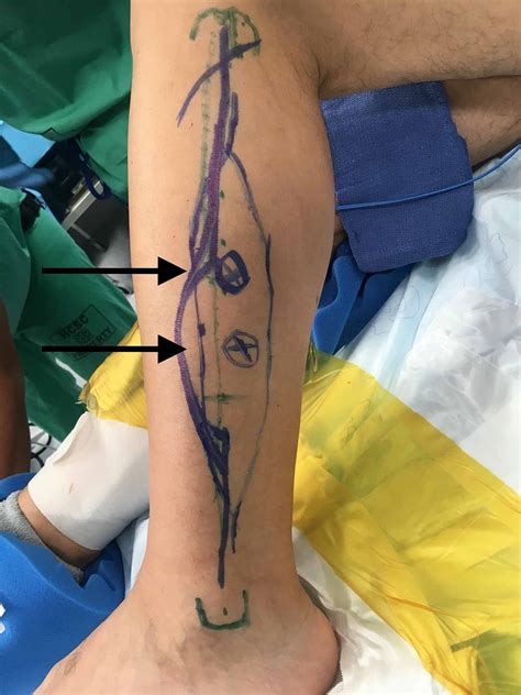 Cureus | Chimeric Free Fibula Flap: An Encounter With Aberrant Anatomy