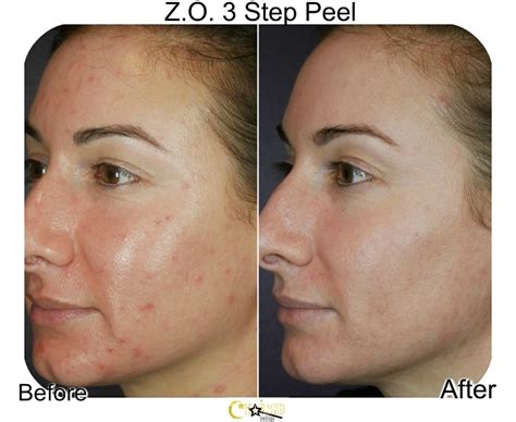 Chemical Peel At Home For Face, Neck and Chest – Charmed Medispa