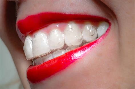 Invisalign for Adults: Everything You Need to Know - Sing Orthodontics