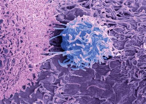 Prostate Cancer Treatment May Rewire Tumor Engine, Potentially Increasing Aggressiveness