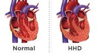 Hypertensive Heart Disease: Types, Symptoms, and Diagnosis