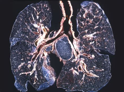 Black lung: Definition, symptoms, and when to seek help