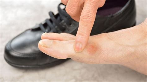 Treatments for Bunion Pain in Dublin | Foot Focus Clinic