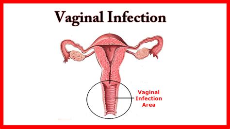 Vaginal Infection: Yoni Smasaya ke Mukhaya Symptoms or Precautions