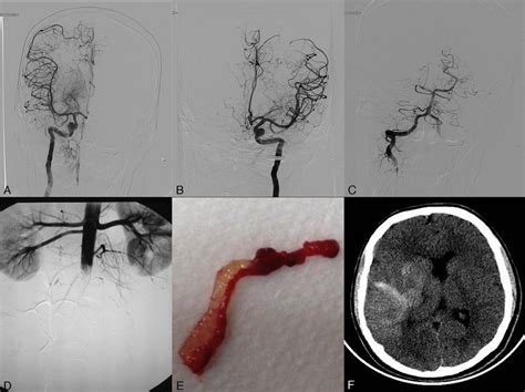 (A) Angiogram of the right internal carotid artery (anteroposterior... | Download Scientific Diagram