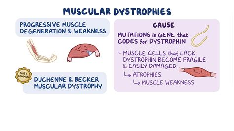 Duchenne Vs Becker Muscular Dystrophy | Hot Sex Picture