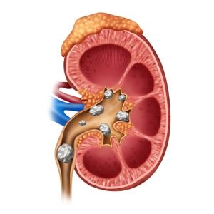 Kidney Stones in Children - NIDDK