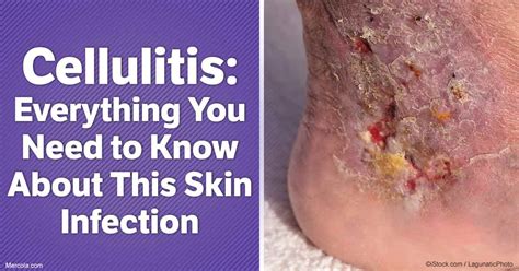 Cellulitis: Everything You Need to Know About This Skin Infection