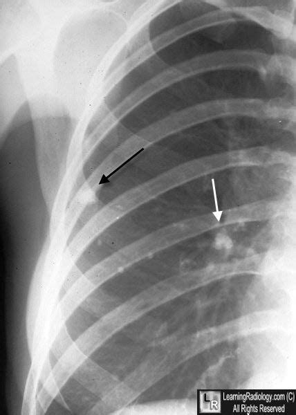 Ranke complex - Ranke Complex. There is a combination of a calcified peripheral granuloma (black ...