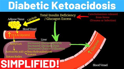 What is Diabetic Ketoacidosis? - Complications of Diabetes | Panmedicad ...