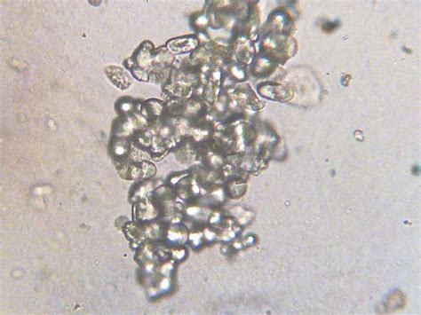 Calcium Oxalate Crystals In Clump