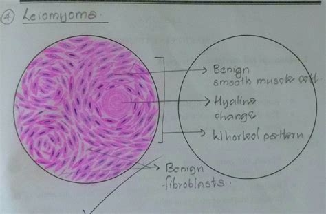 Histopathology Drawings: Leiomyoma