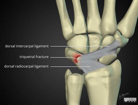 Carpal Bone Fracture