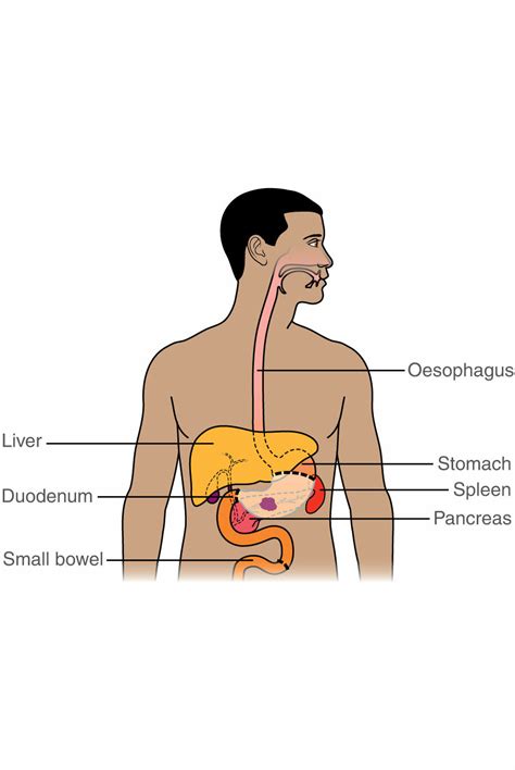 Partial Gastrectomy