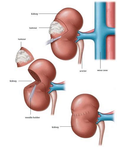 Radical Nephrectomy at best price in Raigad by IndianMedTrip Healthcare Consultants | ID ...