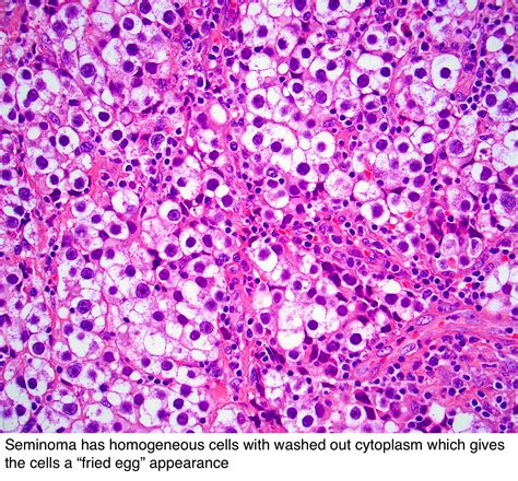 Pathology Outlines - Seminoma