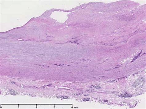 Section of the aorta with lymphatic aggregates near by the vasa vasorum ...