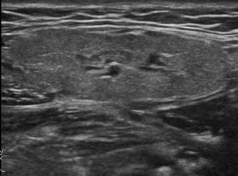 Head and Neck | 4.3 Salivary glands : Case 4.3.1 Salivary gland calculi ...