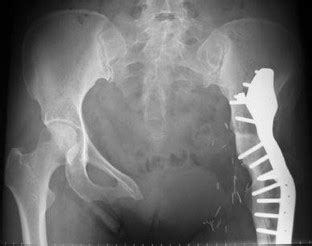 Internal Hemipelvectomy for Pelvic Sarcomas Using a T-incision Surgical Approach | SpringerLink