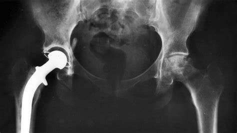 The Trouble with Stryker Hip Implants - ClassAction.com