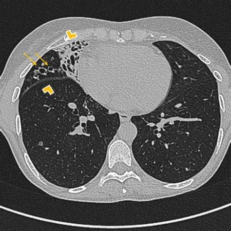 Lady Windermere Syndrome, a rarely considered entity: A case in South ...